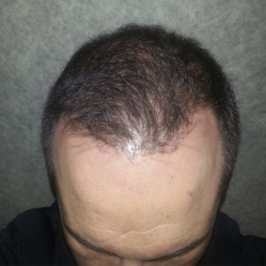 Cuidados post injerto capilar