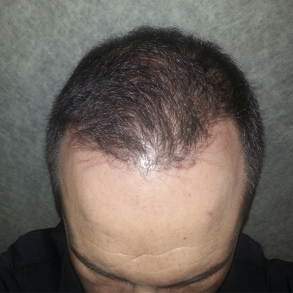 Cuidados post injerto capilar